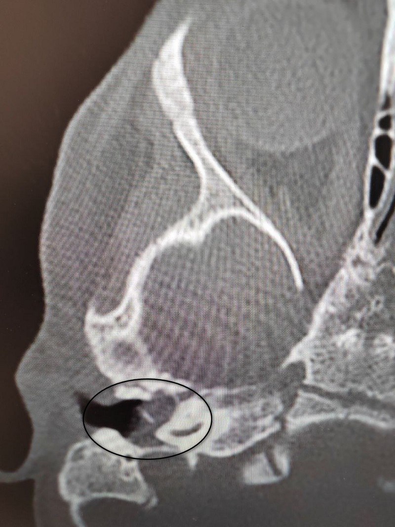 Врачи вылечили редкое заболевание у 2-летней девочки и сохранили ей слух