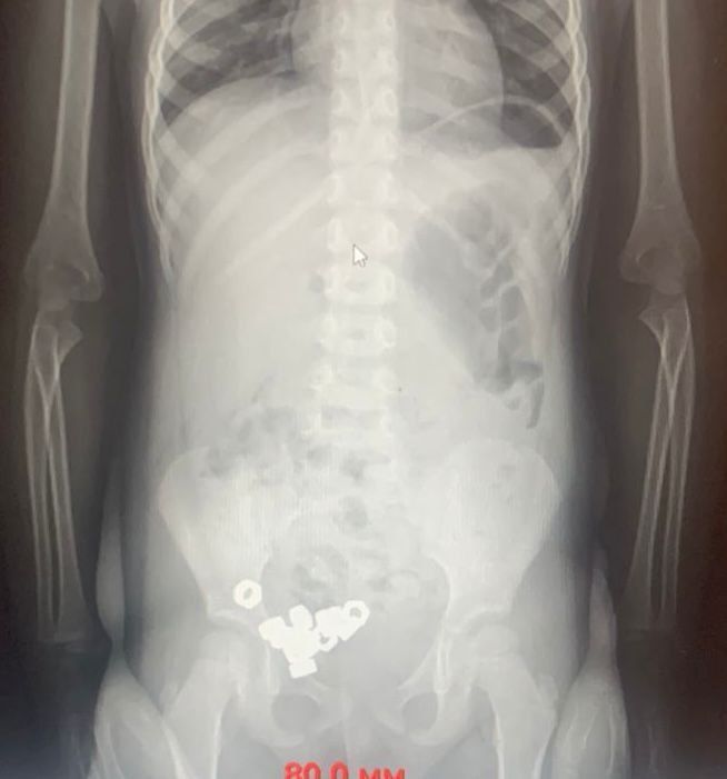 В Воронеже малыш проглотил 16 гаек