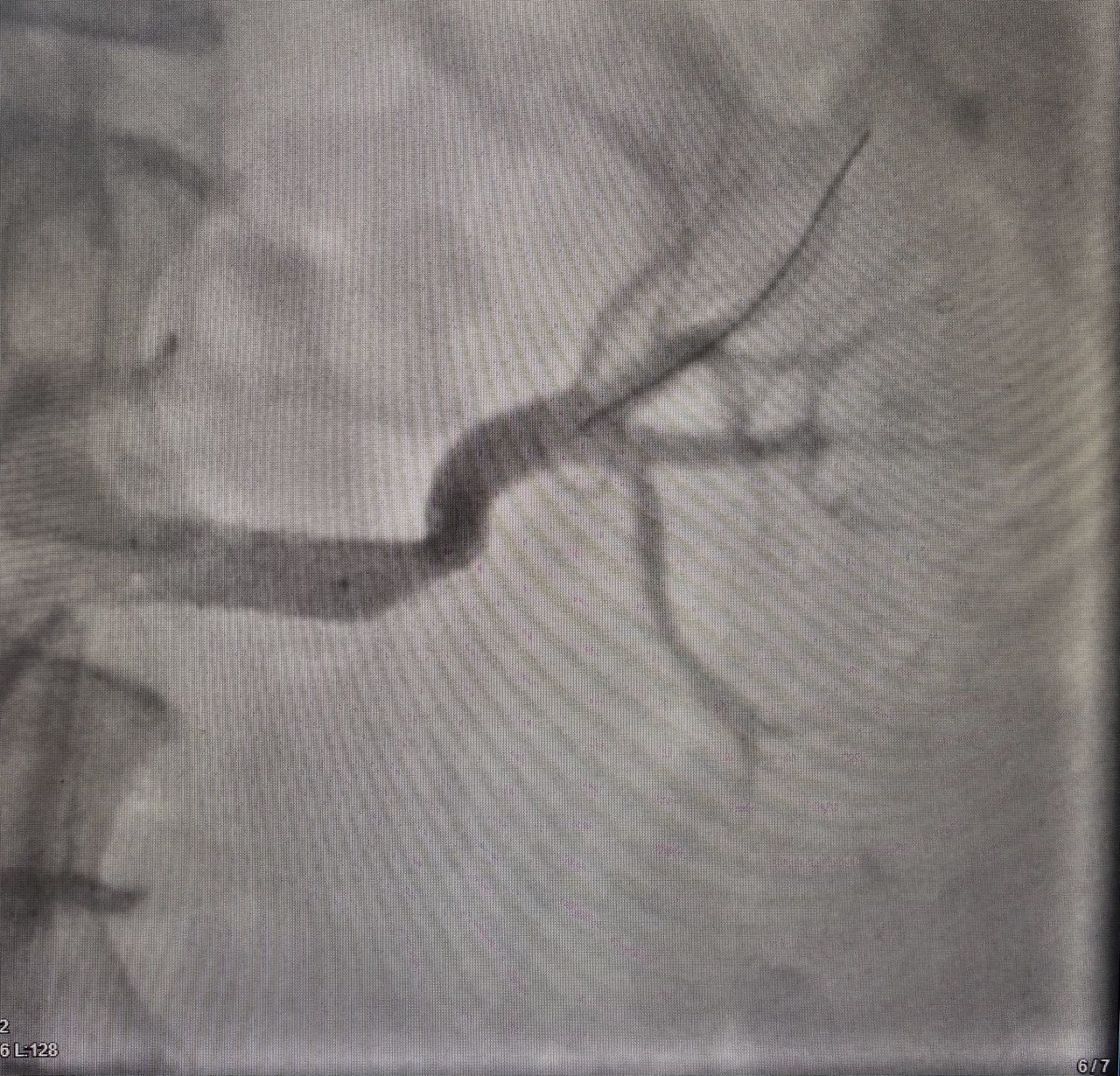 Воронежские врачи спасли пациентку с редкой формой гипертонии, которая годами угрожала жизни женщины Воронежские врачи спасли пациентку с редкой формой гипертонии, которая годами угрожала жизни женщины