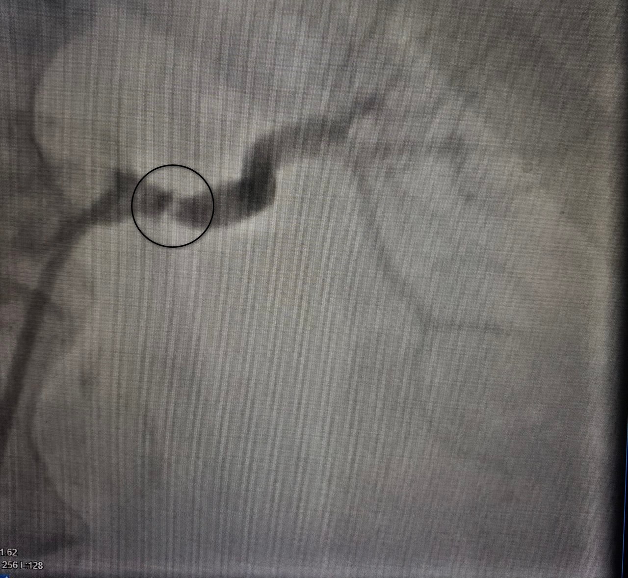 Воронежские врачи спасли пациентку с редкой формой гипертонии, которая годами угрожала жизни женщины
