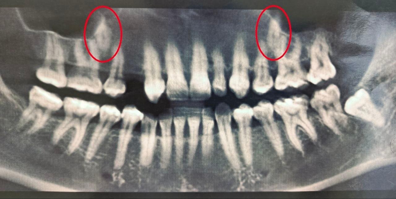 Воронежские стоматологи помогли 38-летней женщине с двумя непрорезавшимися зубами в основном ряду
