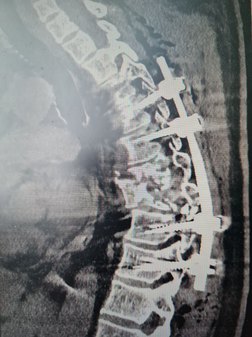 Сломанный позвоночник и угроза инвалидности: как в Воронеже поставили на ноги жертву ДТП Сломанный позвоночник и угроза инвалидности: как в Воронеже поставили на ноги жертву ДТП