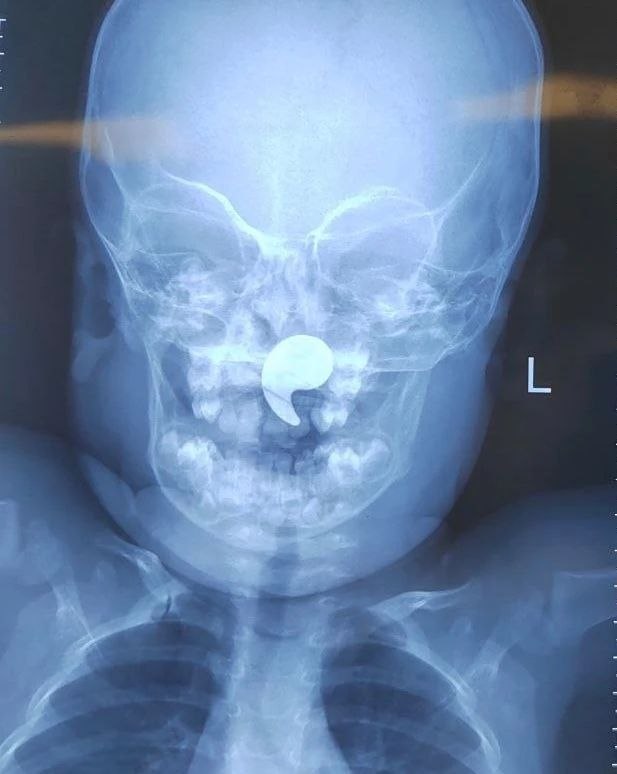 1,5-годовалая малышка едва не задохнулась из-за магнита в Воронеже