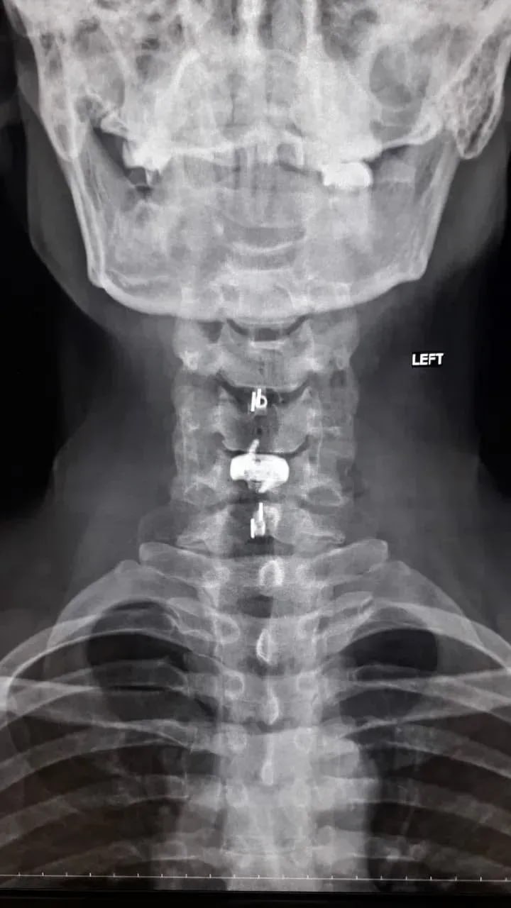 Уникальная операция вернула воронежцу возможность свободно двигать руками Уникальная операция вернула воронежцу возможность свободно двигать руками