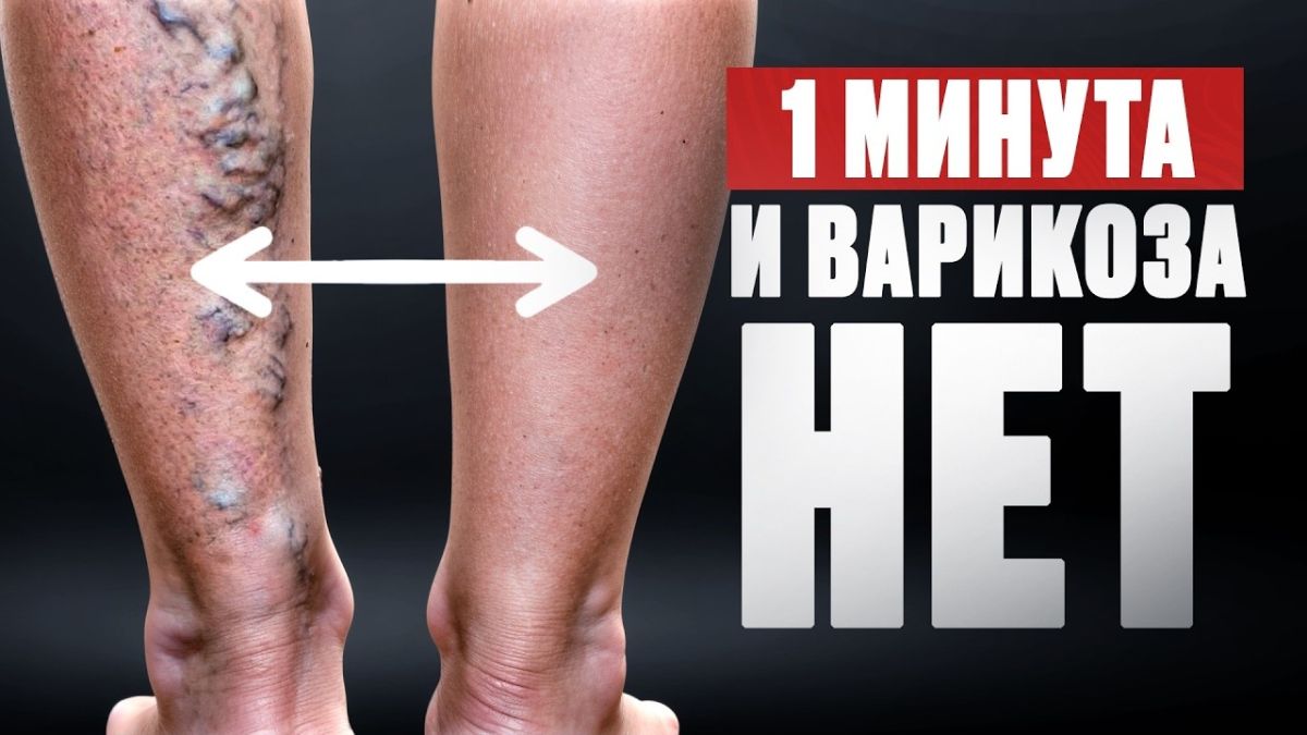 Как одно упражнение может помочь при варикозе: мифы и реальность