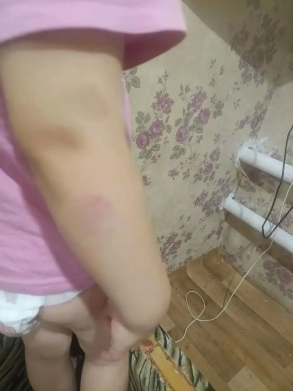 19 укусов нашли на теле 3-летней малышки в детском садике 19 укусов нашли на теле 3-летней малышки в детском садике